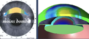 opération-presbytie-multifocalité-modérée